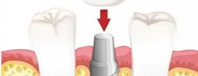 Entreprises 4 image KUNSTGEBIT EN TANDIMPLANTAAT SPECIALIST tandartspraktijken dans Sint-Niklaas VOV