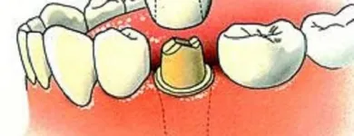 Entreprises 3 image KUNSTGEBIT EN TANDIMPLANTAAT SPECIALIST tandartspraktijken dans Sint-Niklaas VOV